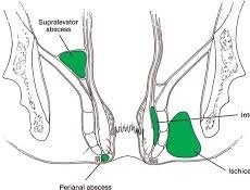 Abscesos anales